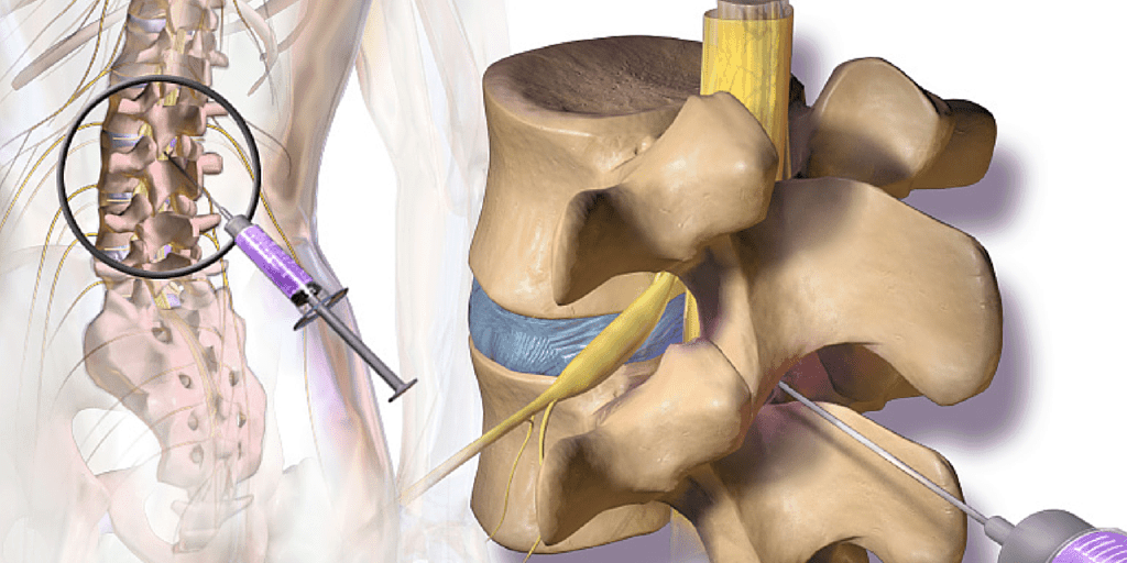 When to Find an Attorney after a Spinal Injury Steroid Injections